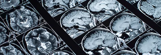 MedicalPoint International Hospital What is a brain tumor