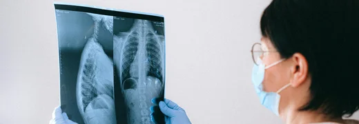 What Is Lung Fluid Build Up Pleural Effusion
