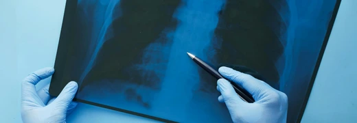 collapsed lung medicalpoint international hospital