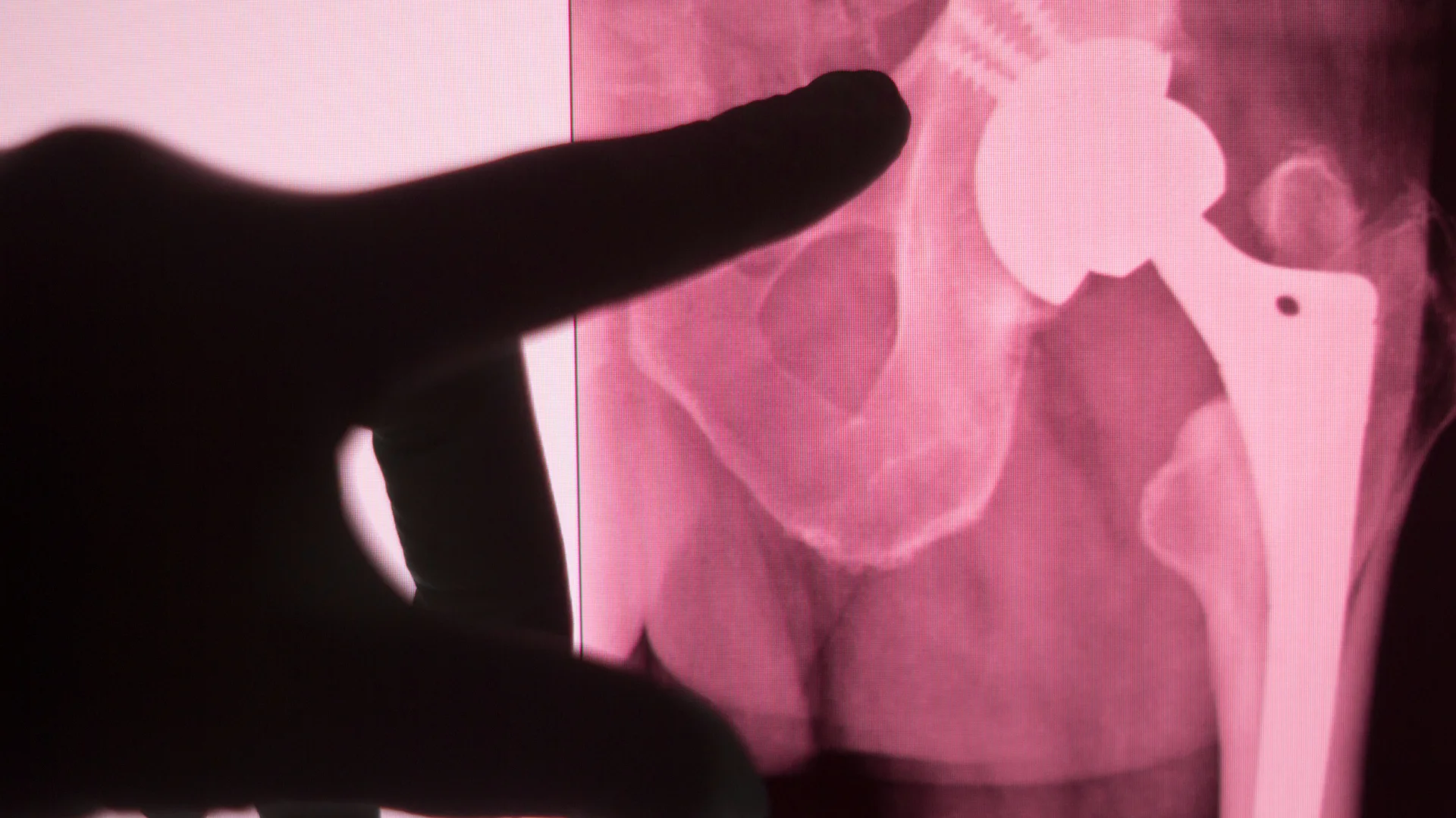 hip replacement medicalpointinternational hospital 2