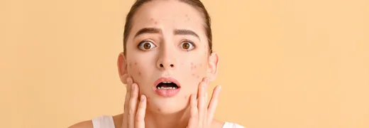 What Causes Acne Pimples and How to Treat It